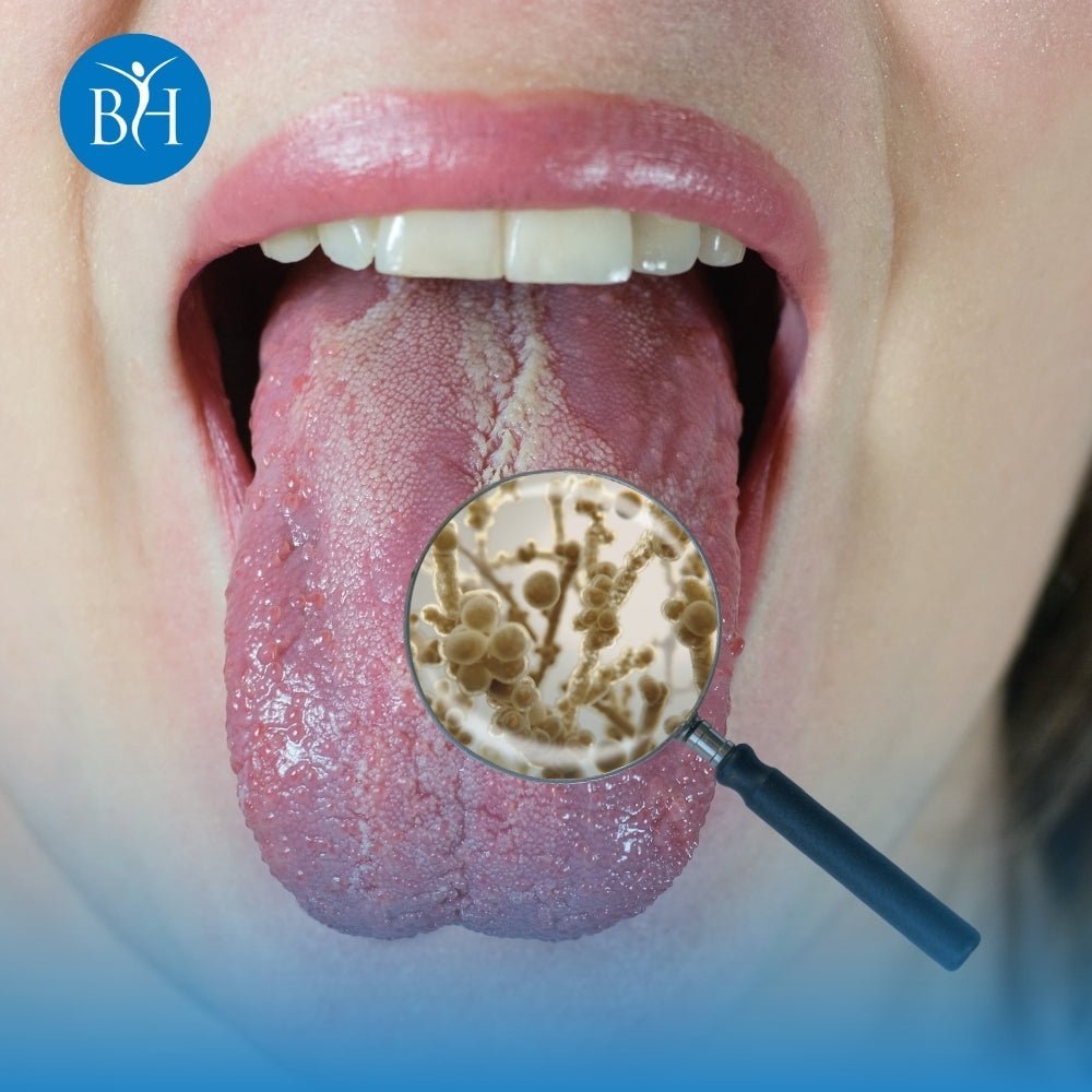 Oral candidiasis, or oral thrush, is a common fungal infection of the mouth  caused by an overgrowth of the yeast Candida albicans, appearing as white,  cottage cheese-like patches on the tongue, inner ..., image size:1000x1000